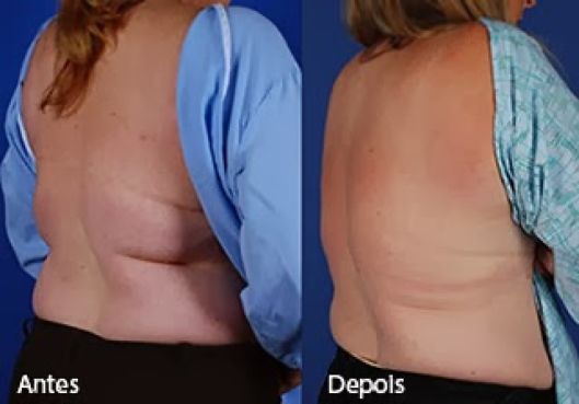 antes e depois da criolipólise nas costas