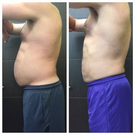 Criolipolise na barriga para homem antes e depois