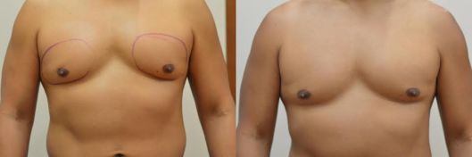Resultado antes e depois de criolipólise para lipomastia